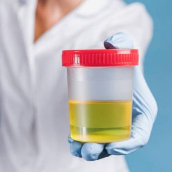 istockphoto-1219723567-612x612 Doctor in white uniform and blue medical gloves holding container for urine analysis. Urine testing for diseases and drugs in clinic